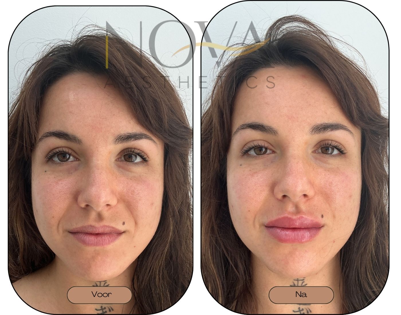 Lipfiller voor en na resultaat