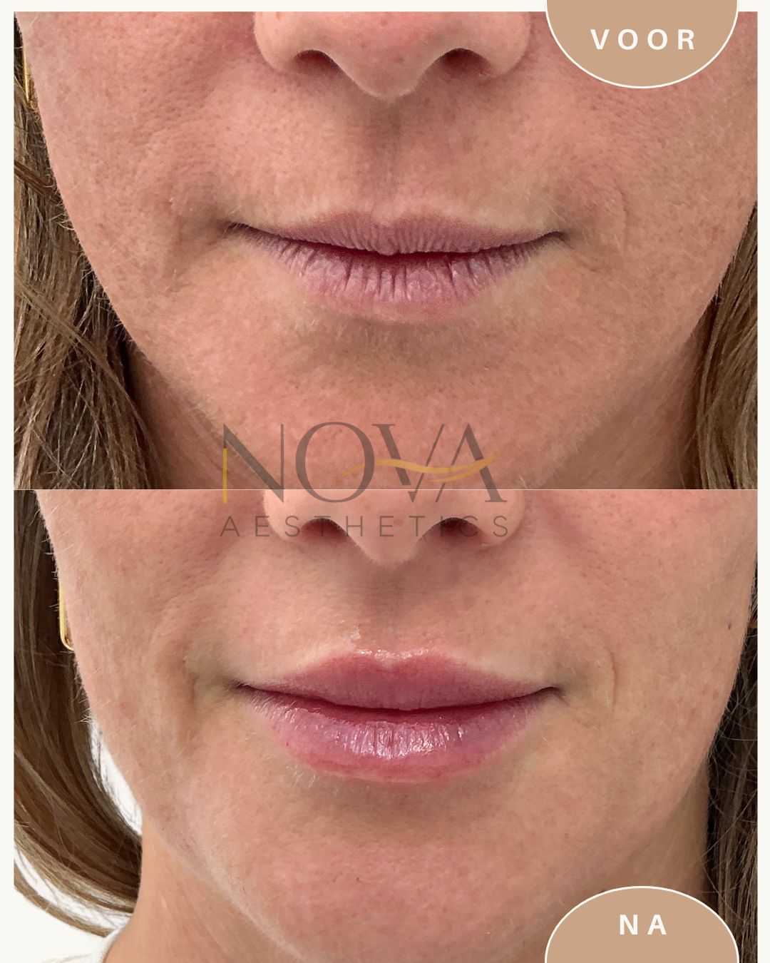 Foto mogelijke resultaten lipfiller Nova Aesthetics