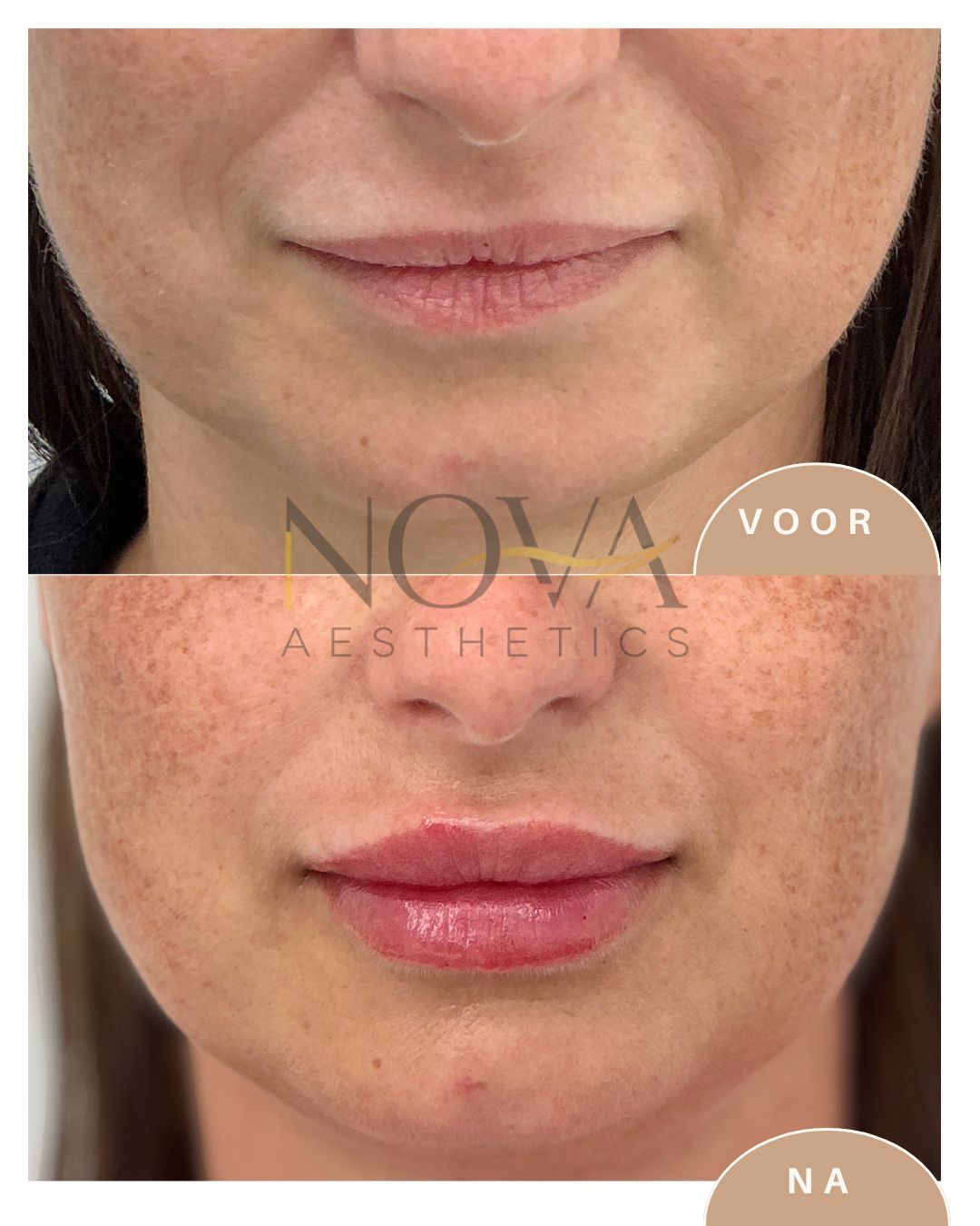 Lipfiller voor en na resultaat Nova Aesthetics